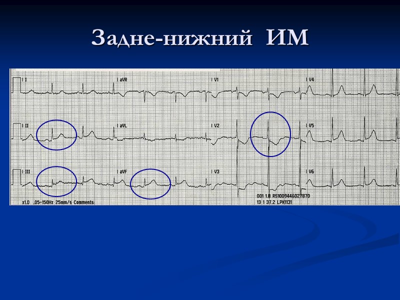 Задне-нижний  ИМ